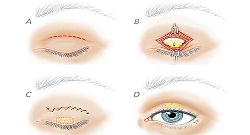 Blepharoplasty