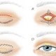 Blepharoplasty