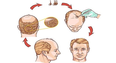 HAIR-TRANSPLANTATION