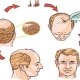HAIR-TRANSPLANTATION