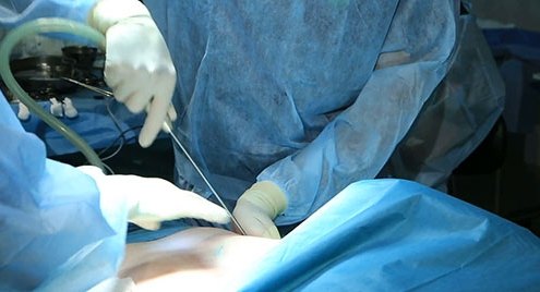 Liposuction