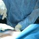 Liposuction